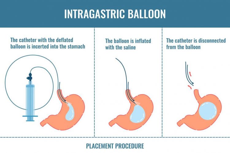 Ballon gastrique Vs Anneau gastrique : préférez le ballon gastrique