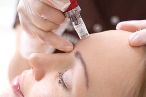 le Microneedling