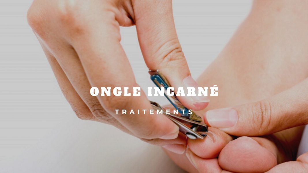 ongle incarné